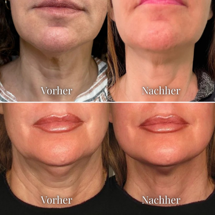 Feybel V-Line Maske - Für definierte Gesichtszüge